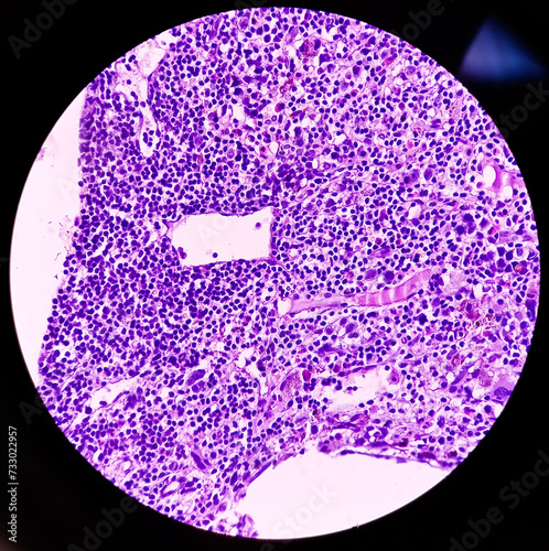 Non-Hodgkin lymphoma(Trephine biopsy tissue). Microscopically show hypercellular cell, megakaryocytes, granulopoiesis with atypical lymphocytic population of cells. photo