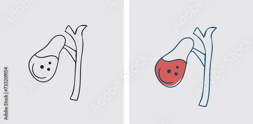 Open cholecystectomy may be necessary if there is severe inflammation, scarring from previous surgeries, or other complications