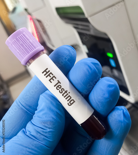 Blood sample for HFE(Hemochromatosis gene) testing, to diagnosis autosomal recessive iron storage disorder. Genetic diagnosis of hereditary hemochromatosis. photo