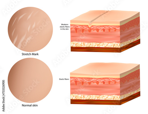 Medical Anatomy Skin Stretch Marks. Collagen elastin. Normal skin and  Stretch Mark 