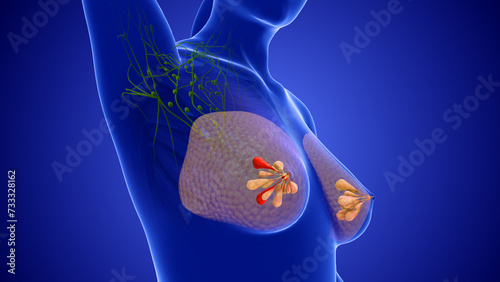 Medical animation for breast cancer