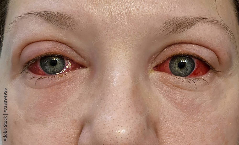 Conjunctivitis - Pink Eyes, Covid-19 Eyes Conjunctivitis - Pink Eyes, Covid-19 Eyes