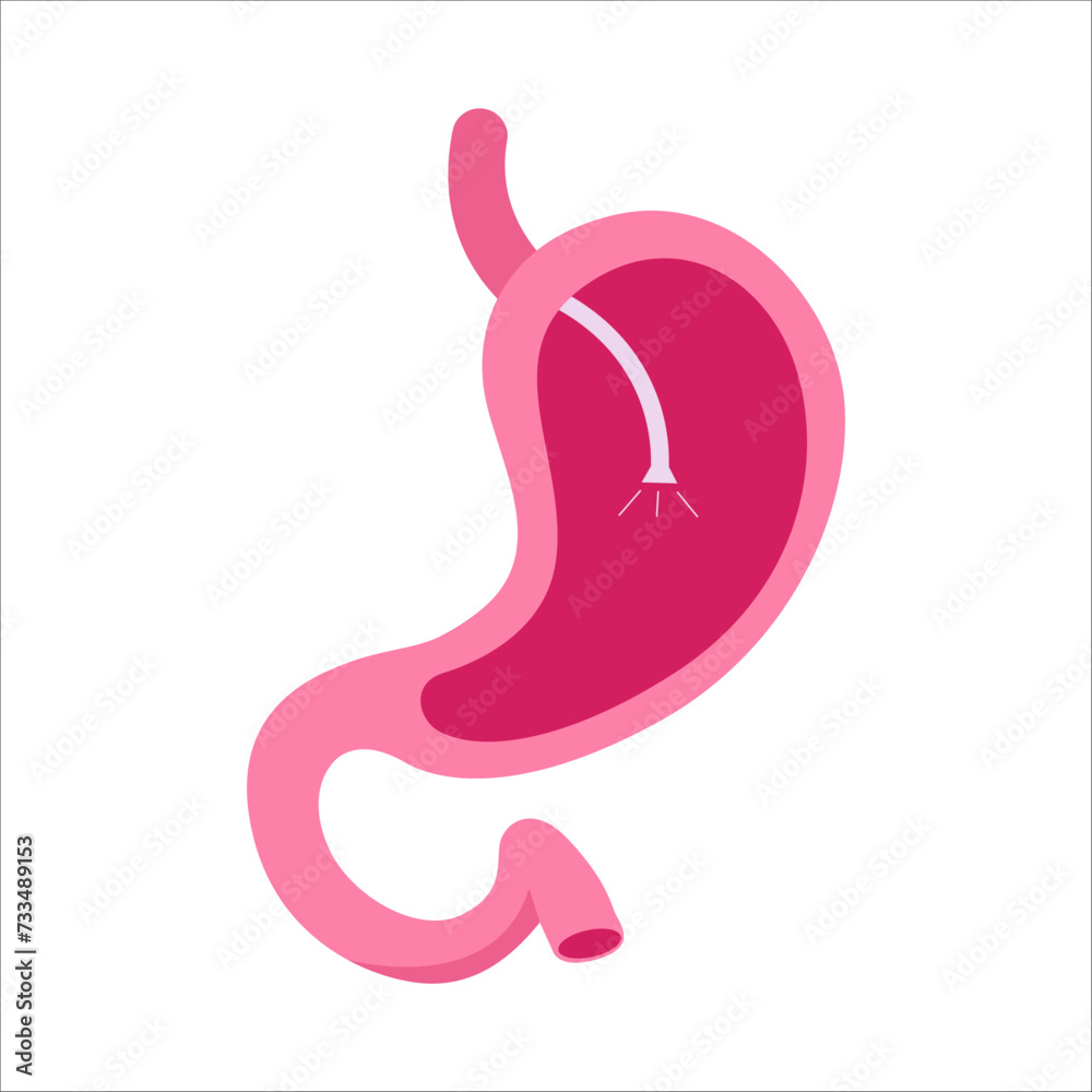 Gastroscopy procedure. Stomach polyps diagnostic. Human gastro. Vector illustration. Gastroscopy procedure. Stomach polyps diagnostic. Human gastro. Vector illustration.