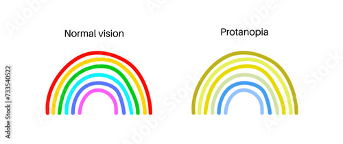 Protanomaly and protanopia