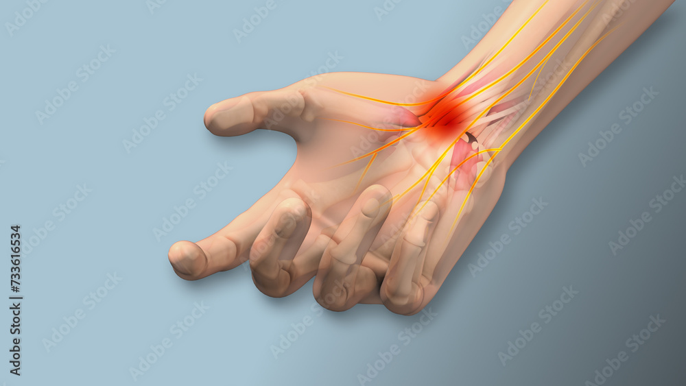  Carpal tunnel syndrome pain, numbness,tingling  - obrazy, fototapety, plakaty 