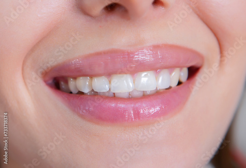 Closeup of female patient showing her beautiful white teeth while having treatment at dental clinic, dentist hands in rubber gloves holding dental tools