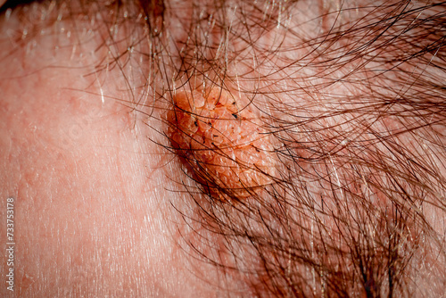Seborrheic keratosis close up.