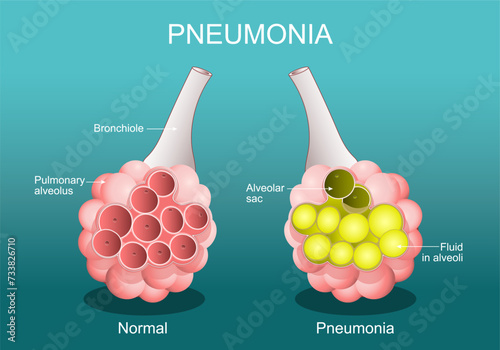 Pneumonia. Cross section of normal alveolus, and Alveoli are filled with fluids.
