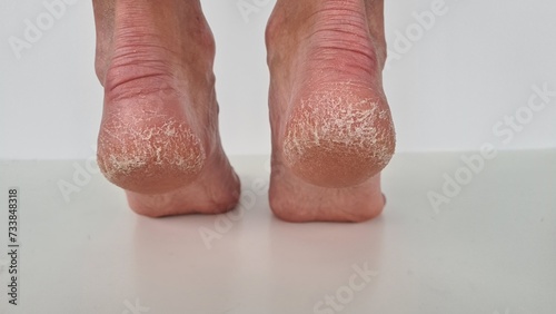 Female feet with cracks and peeling on heels isolated on a white background. Fungal skin infections, allergic diseases photo
