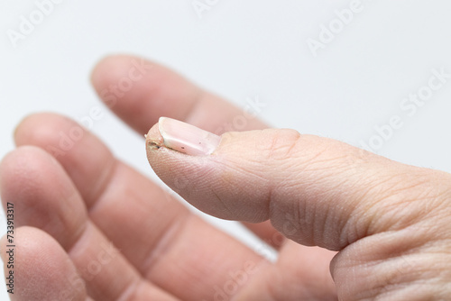 thumb of a woman  hand with cracked skin