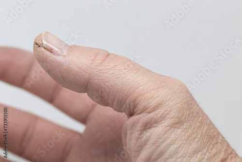 cracked skin on a fingertip