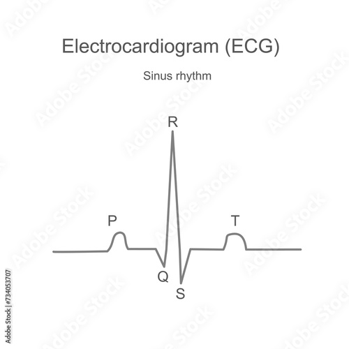 The diagram of Electrocardiogram (ECG) or Electrocardiography (EKG) that reads is a typical sinus rhythm. photo