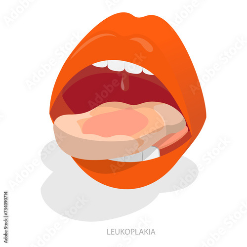 3D Isometric Flat Vector Illustration of Sore Or White Tongue, Definition of the Disease by Tongue. Item 1 photo