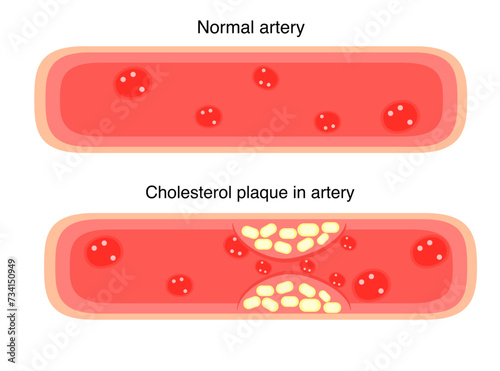 Normal blood vessels artery and cholesterol plaque in artery for heart disease 