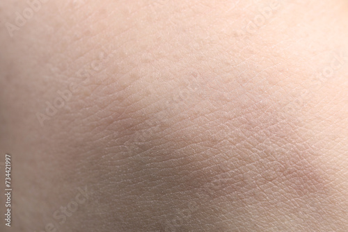 Closeup view of woman with dry skin photo
