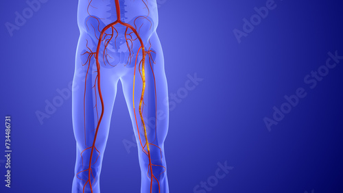 Animation of peripheral artery bypass surgery photo