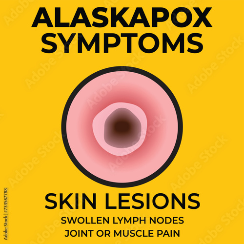 Vector illustration of Alaskapox symptoms with damaged skin close up