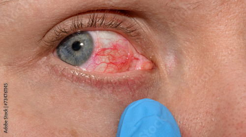 Problem z oczami, zbliżenie na otwarte zaczerwienione białko oko, popękane żyłki 