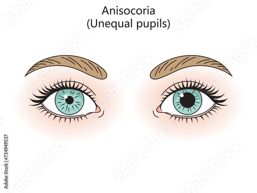 Human eyes with anisocoria diagram hand drawn schematic raster illustration. Medical science educational illustration photo
