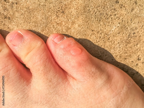 Billede på lærred The friction blisters on the little toe