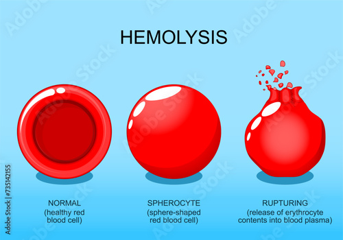 Hemolysis. Normal red blood cell, spherocyte, and rupturing of erythrocyte.