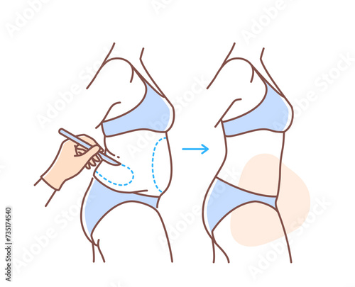 Plastic surgery body doodle. Woman with liposuction. Skincare and beauty treatment, spa procedures. Graphic element for website. Linear flat vector illustration isolated on white background