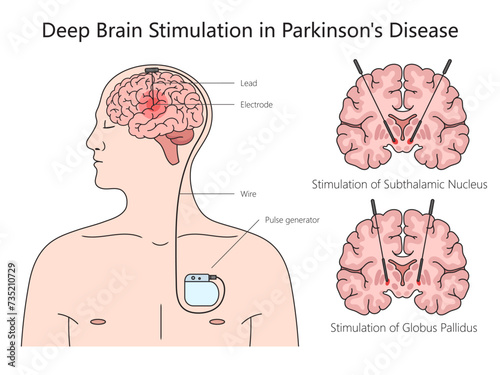 Deep brain stimulation structure Parkinson disease diagram hand drawn schematic vector illustration. Medical science educational illustration