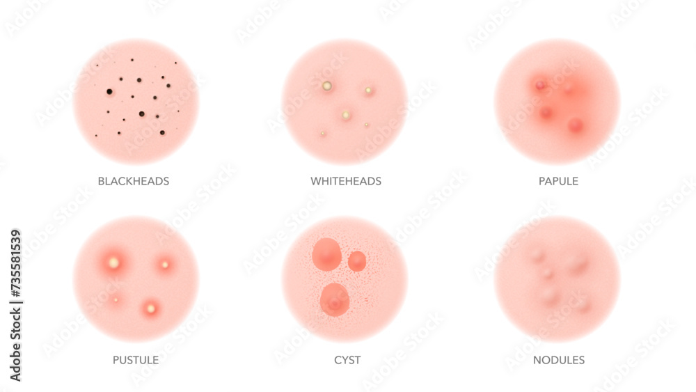 Acne types, body or face skin pimples and inflammation problems, vector ...