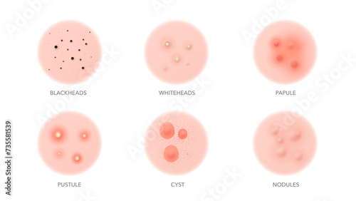 Acne types, body or face skin pimples and inflammation problems, vector icons. Acne types, blackhead, pustule or whitehead, papule and cyst with nodules for skincare beauty cosmetology and dermatology photo