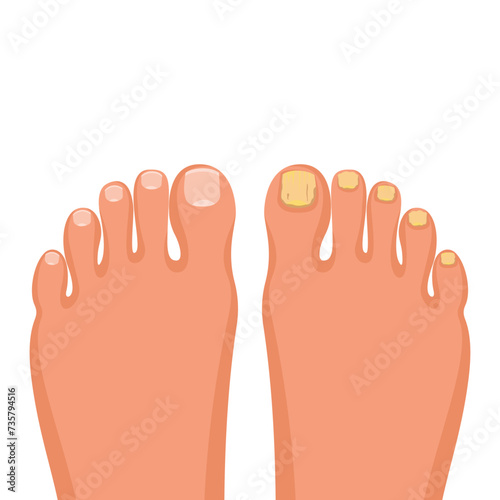 Nail disease. Onychomycosis concept. Fungal nail infection. Paronychia is inflammation of the skin around the toenail. Fungal disease, psoriasis. Vector illustration flat design.