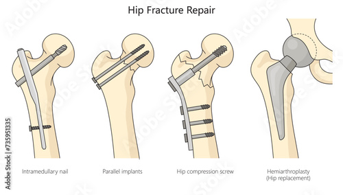 hip fracture treatment repair diagram hand drawn schematic vector illustration. Medical science educational illustration