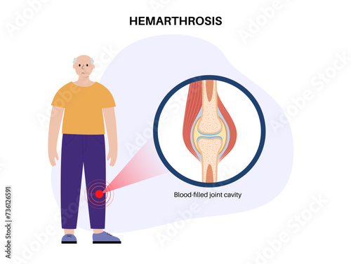 Hemarthrosis in the synovial joint photo