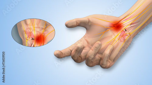 Carpal tunnel syndrome tingling and numbness in hand photo