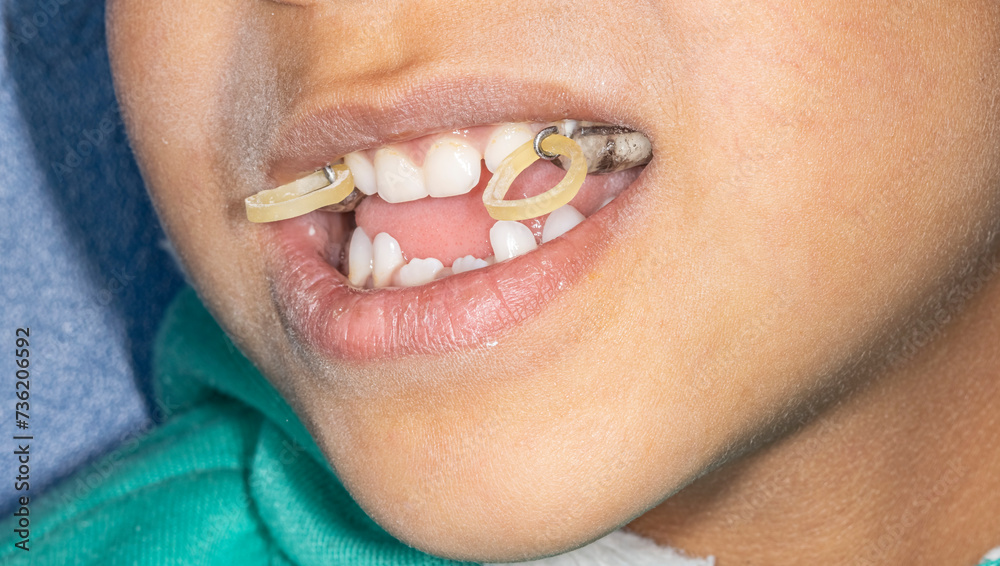 Oblique side view of a young dental patient case. Palatal expander