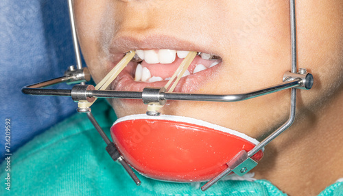 Delaire face mask for orthodontic treatment in pediatric early mixed dentition. Orthopedic protraction of maxilla in Class III and a  maxillary expander with metal hooks connected with elastic bands.