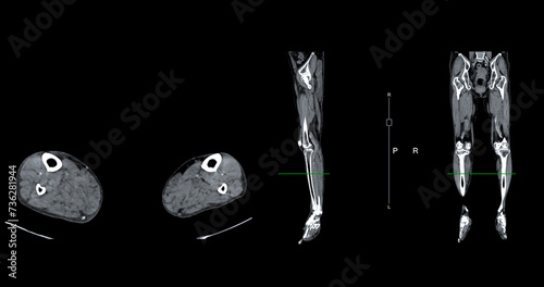 A CT venogram of the leg is a non-invasive imaging procedure offering detailed visuals of leg veins. photo