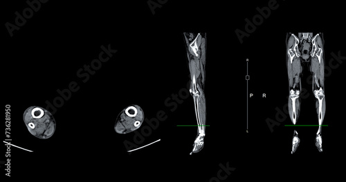 A CT venogram of the leg is a non-invasive imaging procedure offering detailed visuals of leg veins. photo