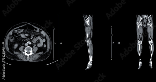 A CT venogram of the leg is a non-invasive imaging procedure offering detailed visuals of leg veins. photo