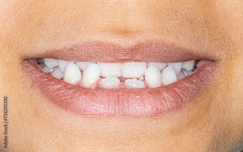 Frontal view of a young girl with a skeletal Class III malocclusion biting teeth lips open. Milk teeth and permanent incisors, anterior crossbite because of retruded maxilla or protruded mandible