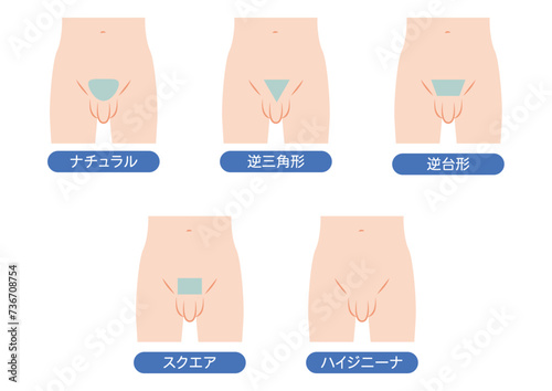 男性のVライン脱毛のデザイン