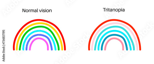 Tritanopia and tritanomaly