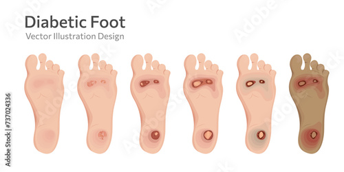 Diabetic foot different stages vector illustration. photo