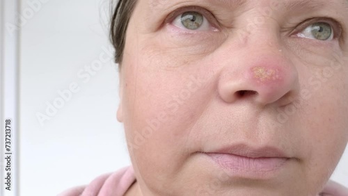 female face close-up, herpes on tip of nose, harbinger of dangerous disease damage to skin and nervous system, concept Women's Skin Health, Managing symptoms and treatment for woman with herpes photo