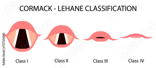 The Cormack–Lehane (CL) classification system classifies views obtained by direct laryngoscopy based on the structures seen. Medical procedure vector illustration isolated on white background. photo