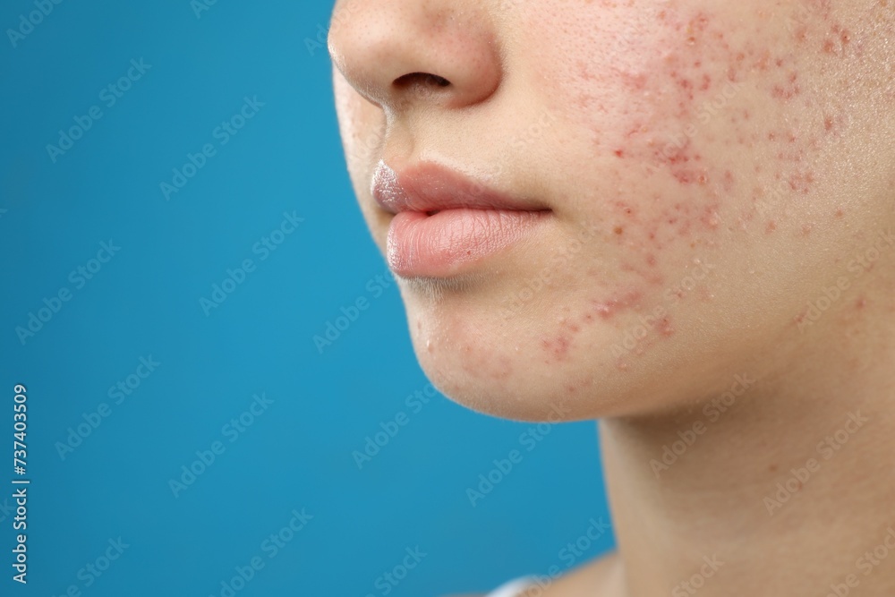 Obraz premium Teenage girl with acne problem on blue background, closeup