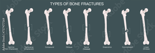 Types of bone fracture. Structure of a bone vector illustration. The quality or structure changes in marrow density. Build and strength of bone tissues. Stymptoms and stages and growth. Bone anatomy.