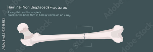 Types of bone fracture. Structure of a bone vector illustration. The quality or structure changes in marrow density. Build and strength of bone tissues. Stymptoms and stages and  growth. Bone anatomy.