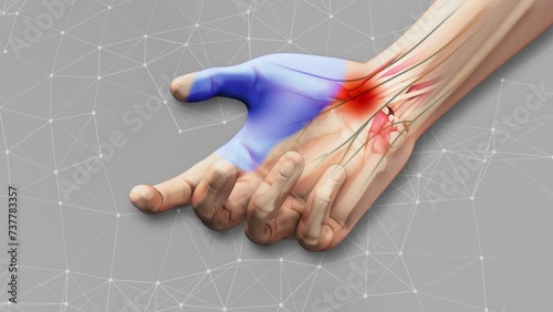 Carpal tunnel syndrome with plexus background photo