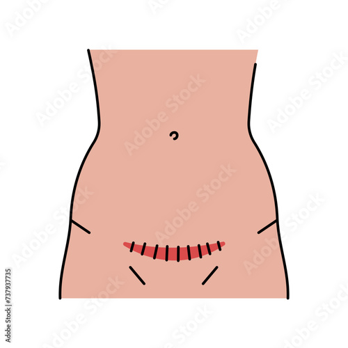 Pfannenstiel incision line icon. Abdominal incisions.