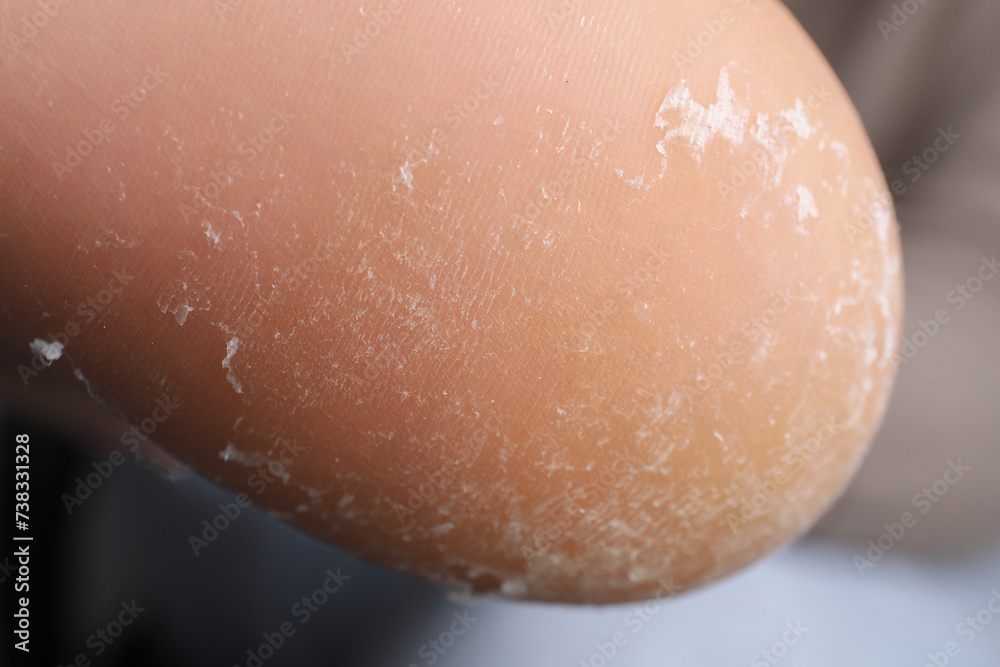 Fototapeta premium Woman with dry skin on foot, closeup
